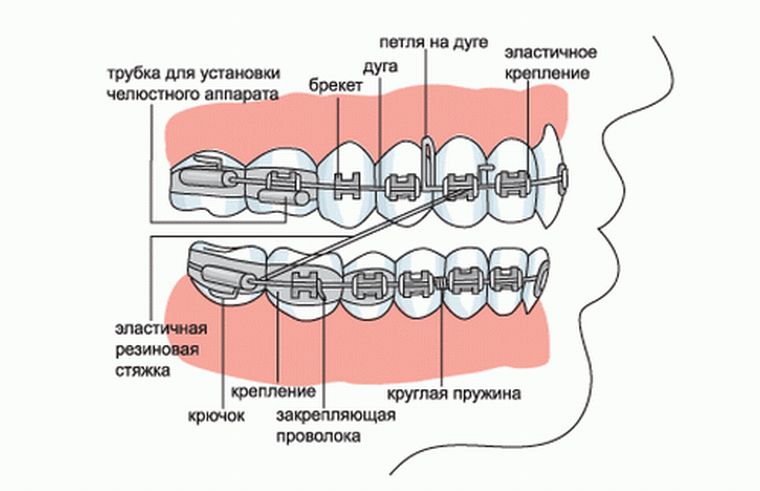 устройсто брекетов