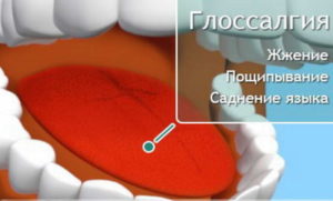 Глоссалгия