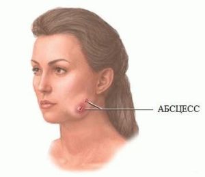Абсцесс мягких тканей лица