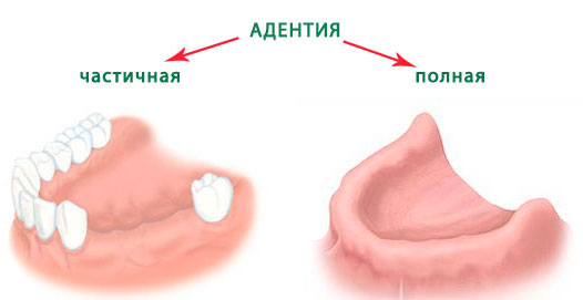 адентия