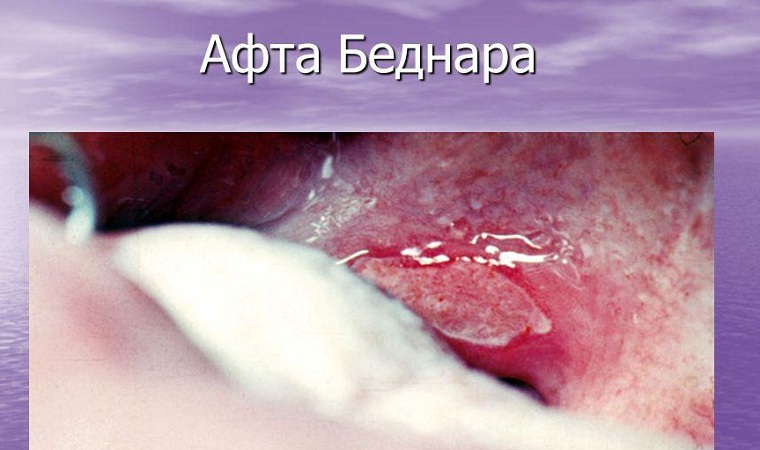 афты беднара