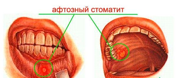 Локализация афтозного стоматита