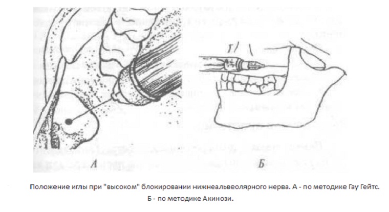 Анестезия Акинози