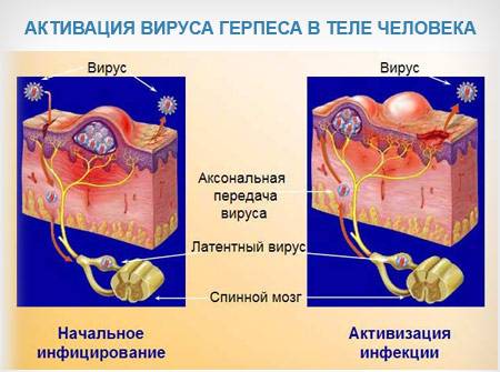 активация вируса герпеса