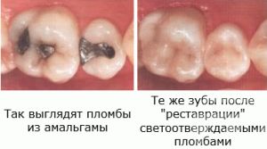 амальгамная пломба