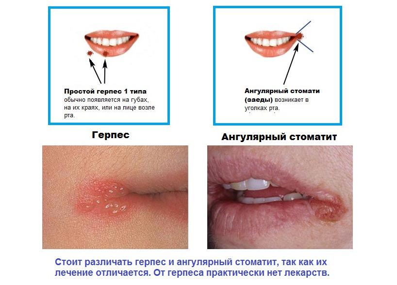 Оличия между герпесом и заедой