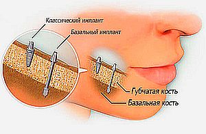 базальный имплант