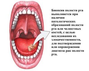 Биопсия
