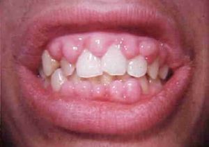 Гипертрофический гингивит