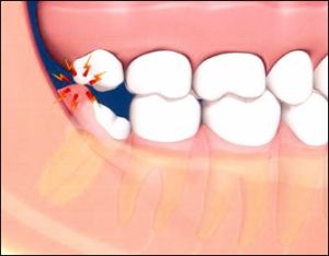 боли в зубе мудрости