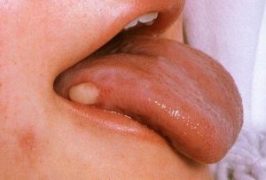 лечение болячек на языке