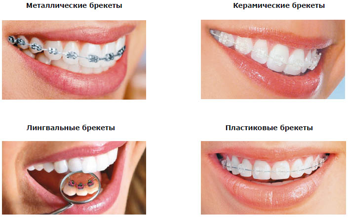 Виды брекетов