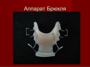 Аппарат Брюкля