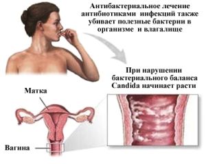 Вагинальная молочница