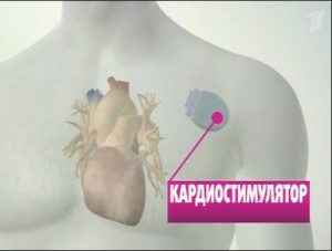 кардиостимулятор