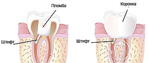 штифтовые зубы