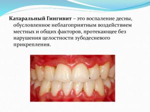 катаральный гингивит