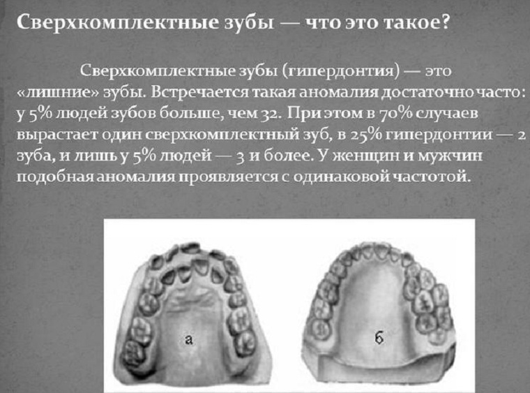 Что такое гипердонтия