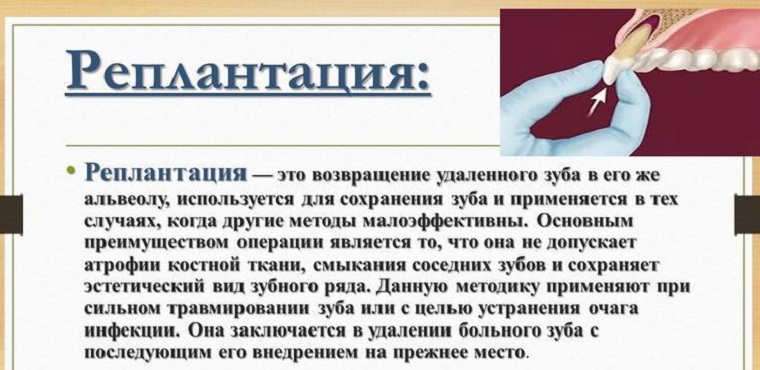 Что такое реплантация