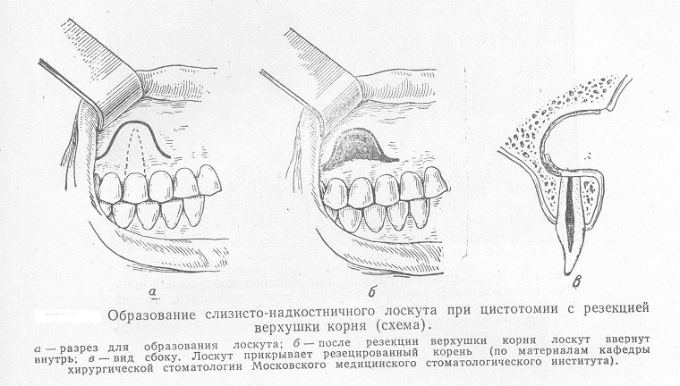 цистотомия зуба