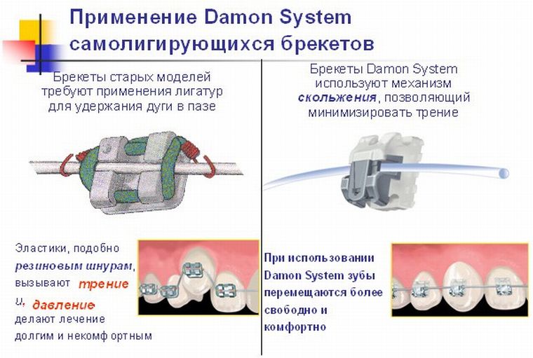 Damon брекеты как работают