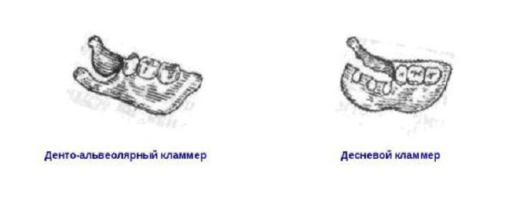 Дентоальвеолярный кламмер