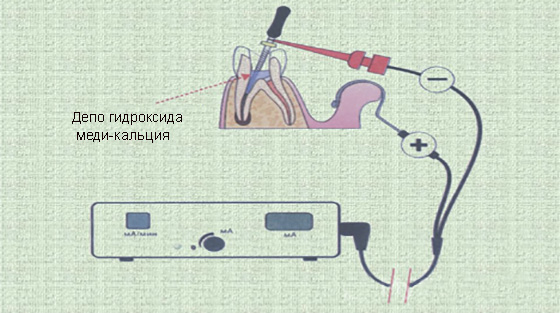 Электрофорез кальцием