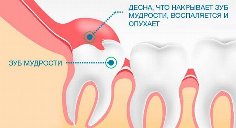 Капюшон над зубом мудрости