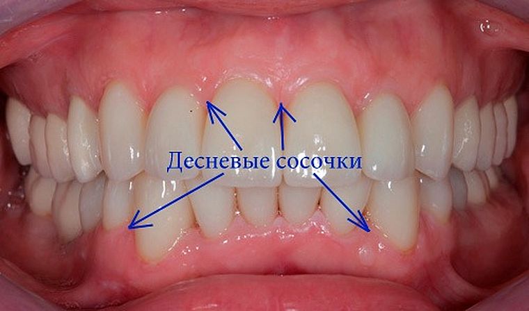 десневой сосочек
