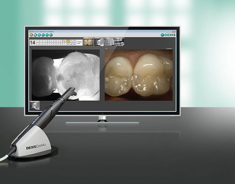 Caries detector