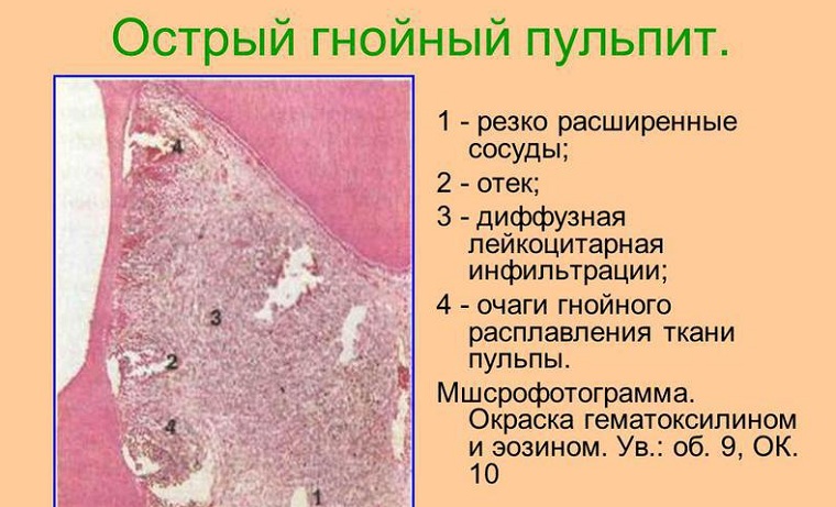 Острый гнойный пульпит на ЭОД