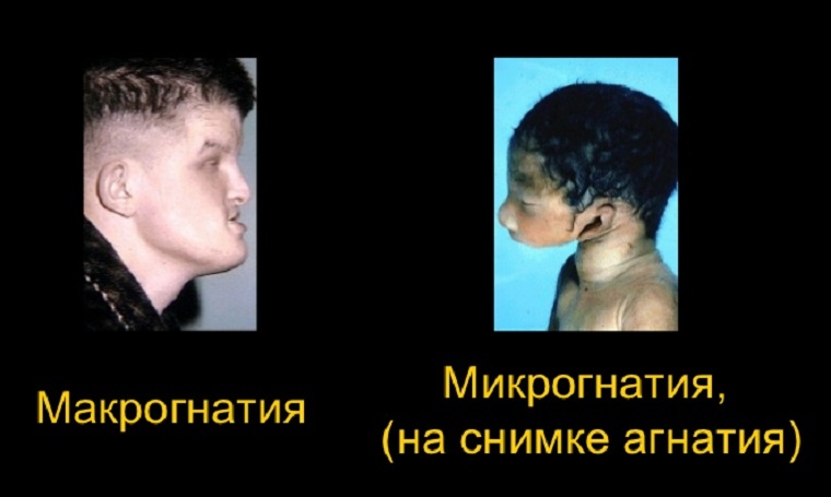 Макрогнатия и микрогнатия