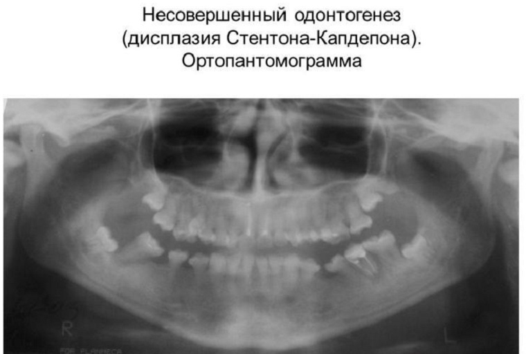 синдром Стентона-Капдепона