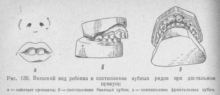 дистальный прикус у ребенка