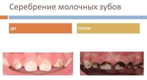 серебрение зубов