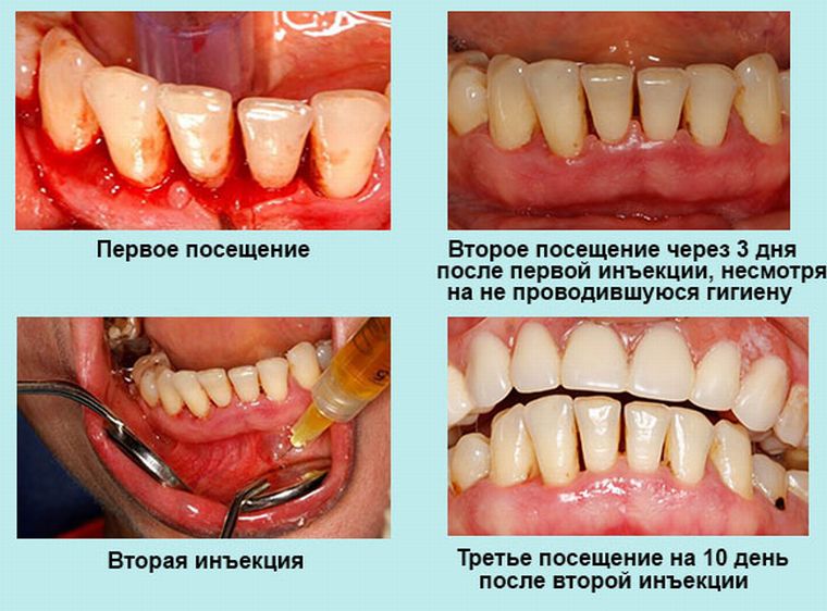 десна до и после лечения