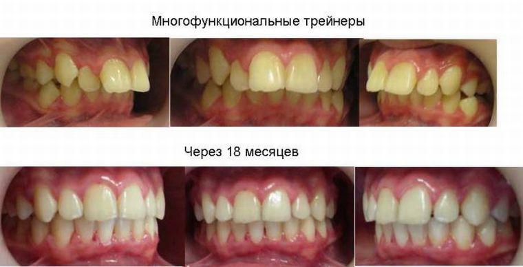 глубокий прикус и его исправление