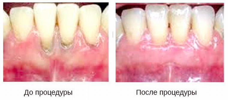 До и посде кюретажа