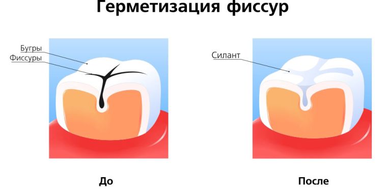 до и после запечатывание фиссру