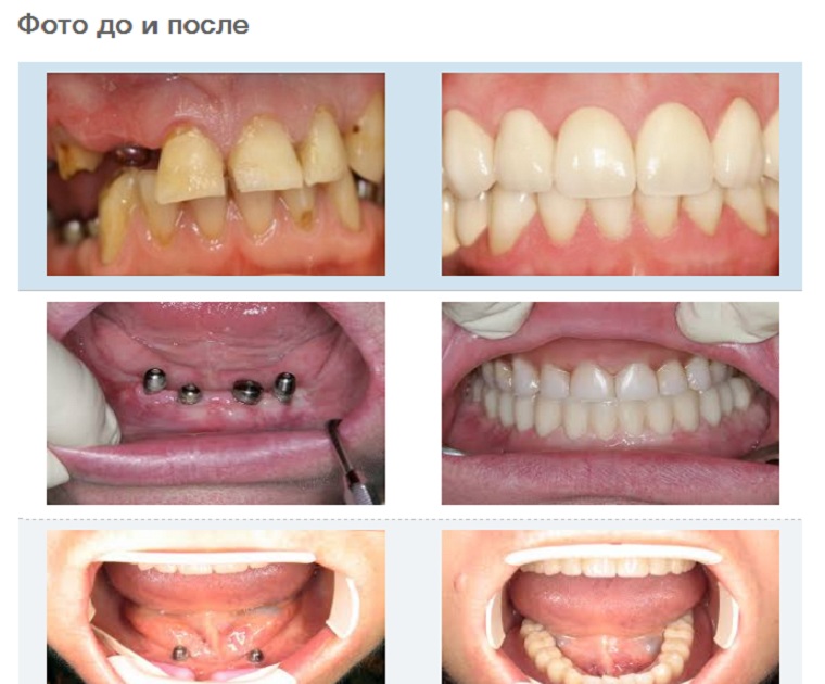 Зубной ряд до и после имплантации