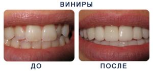 до и после установки виниров
