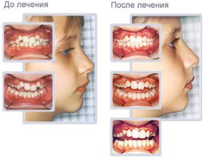 До и после лечения трейнеров