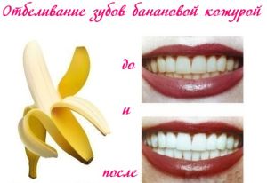 зубы до и после отбеливания