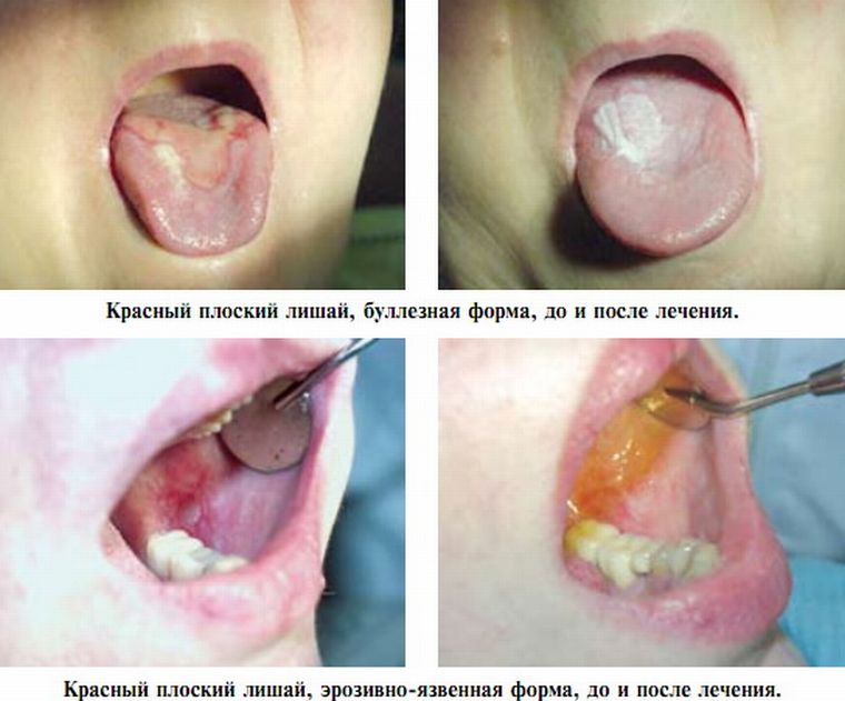 Лечение лишая