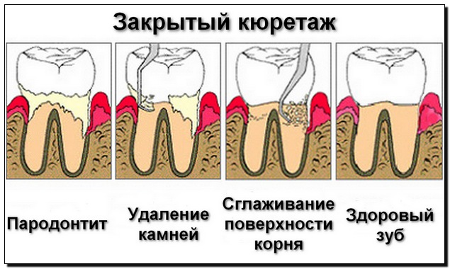 Закрытый кюретаж