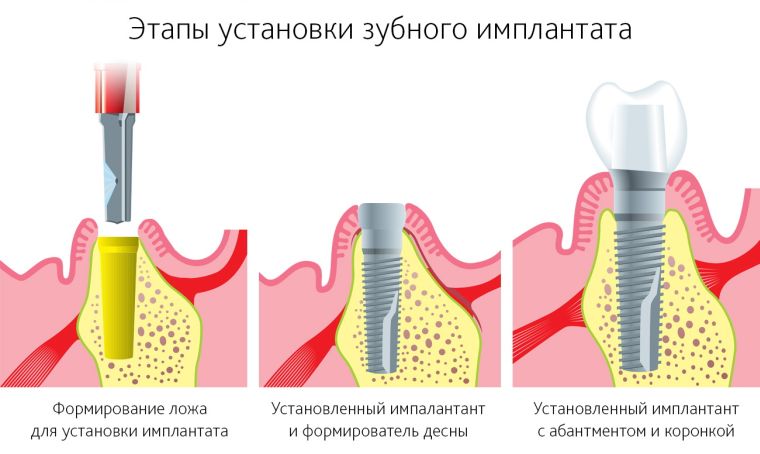 установка зубного импланта