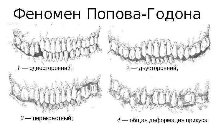 Виды деформации челюсти