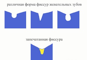 разновидности фиссур