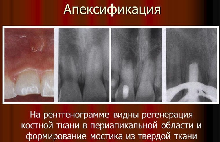 формирование верхушки корня зуба