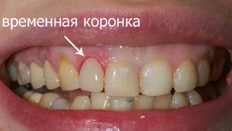 пластмассовые коронки на передние зубы